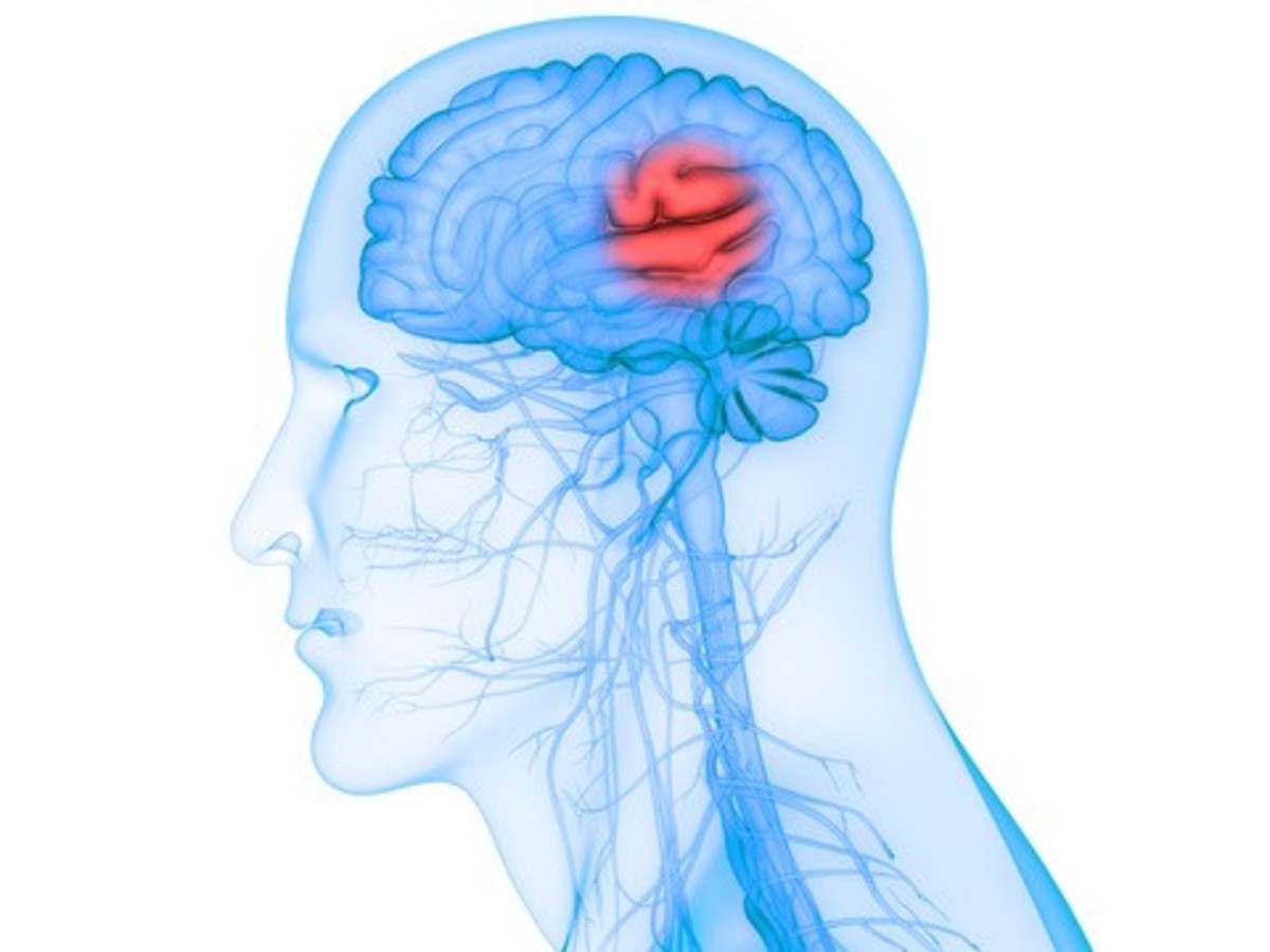 17th Annual Stroke Symposium Stroke Image
