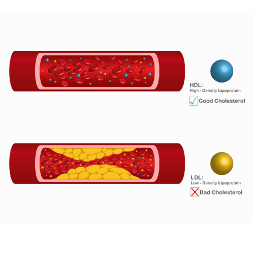 Arteries that are clogged with fat that causes blood clots are a leading cause of death. Types of cholesterol. High-density lipoprotein (HDL) and low-density lipoprotein (LDL