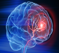 X- Ray illustration of brain stroke - 3d Illustration