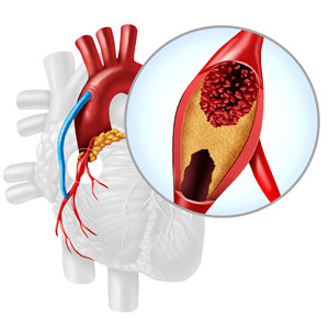 Coronary Artery Bypass Grafting