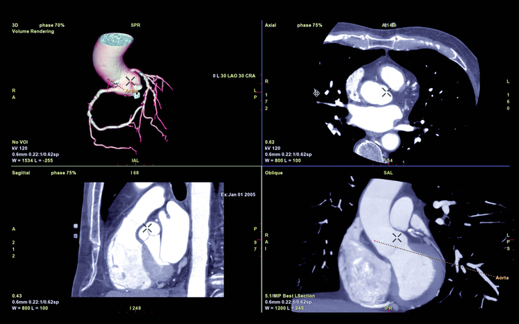 Cardiac CT Angiogram Scan