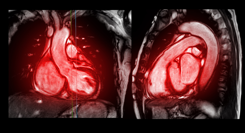 Cardiac MRI (Cardiac MR)