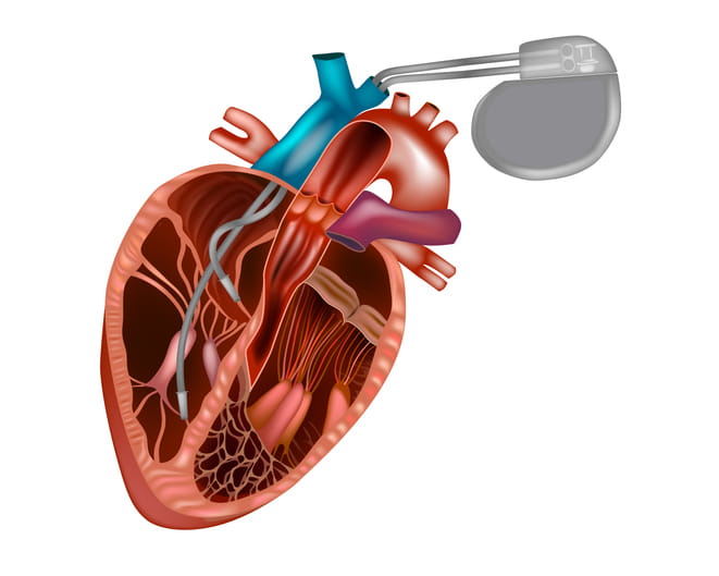 Implanted Medical Devices