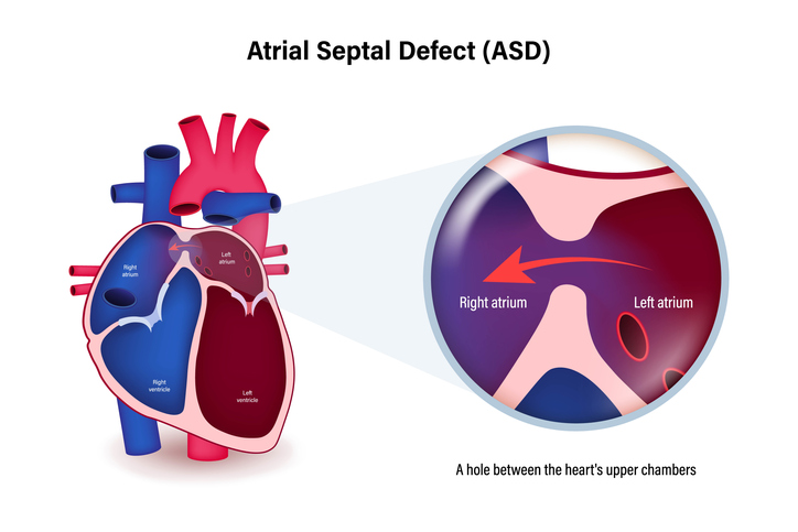 Atrial Septal Defect Closures and Patent Foramen Repair