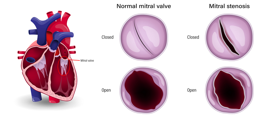 Diseases & Treatments for Mitral Valve Disease graphic