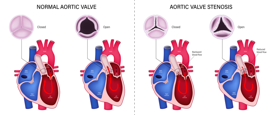 Diseases & Treatments of the Aortic Valve
