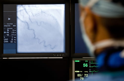 Doctor with mask observing angiography procedure on the monitor, focus on screen