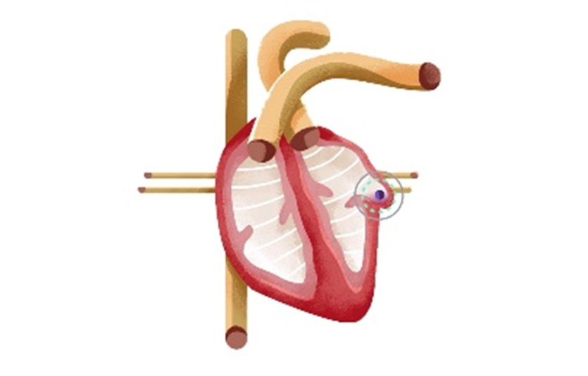 AFib Increases Risk of Stroke Heart Health