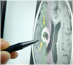 Brain scan with lesion