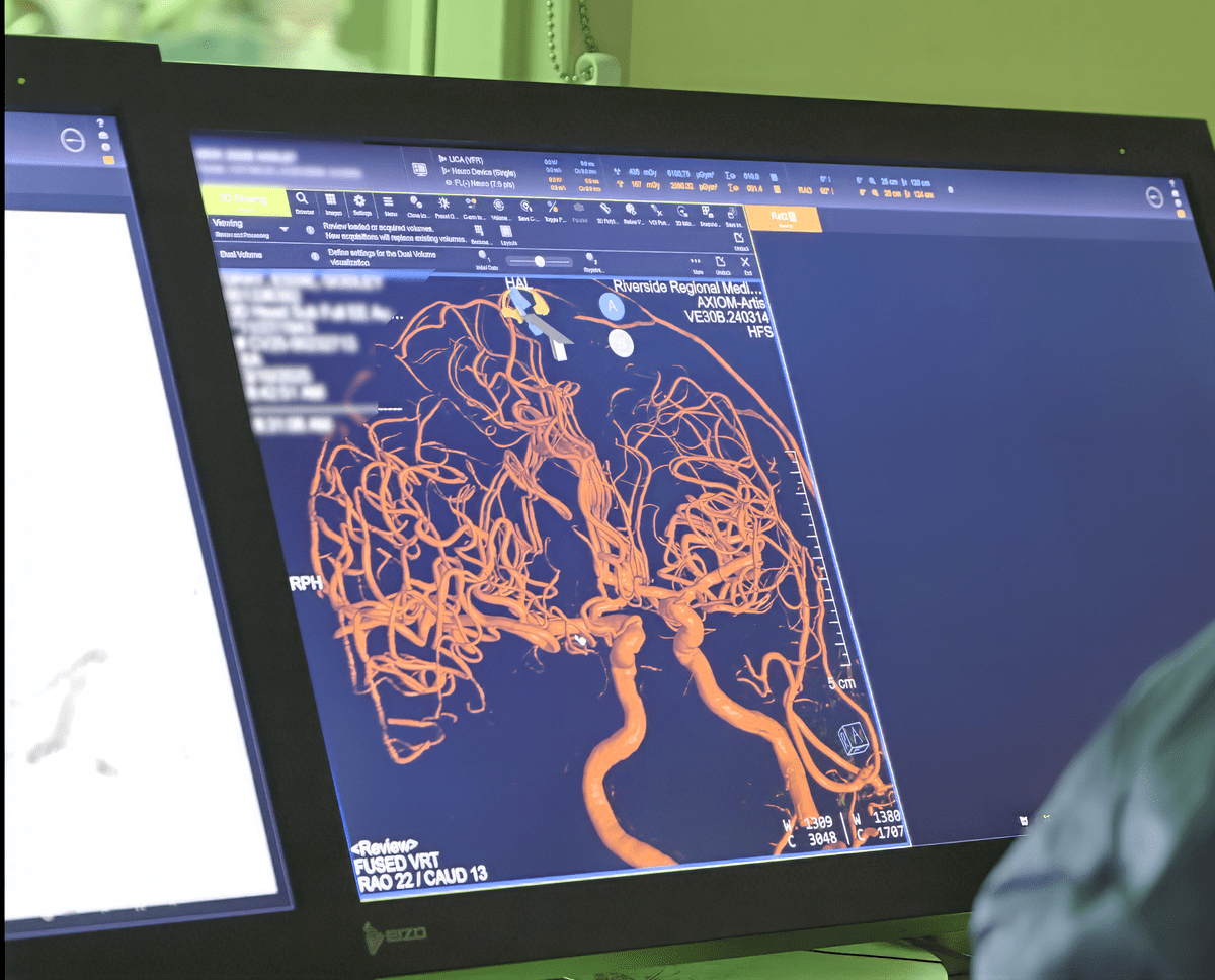 A computer screen displaying a detailed 3D angiogram of a human brain, highlighting complex orange blood vessels against a darker background.