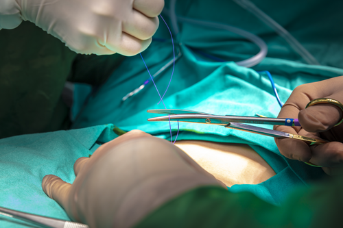 Surgical stitch