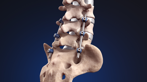 This image illustrate posterior lumbar fusion with pedicle screws and rods is a surgical procedure used to treat various lumbar spine conditions. It involves removing damaged discs, placing a bone graft for fusion, and stabilizing the spine using pedicle screws and rods. The goal is to promote spinal fusion, alleviate symptoms, and improve stability.