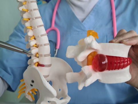 Closeup of female doctor hand with artificial disc herniation and spine model. Treatment of herniated discs and diseases of spine