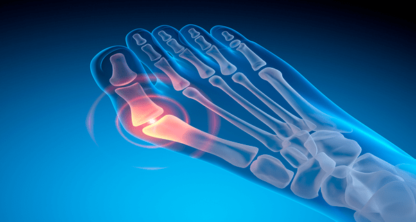  Valgus deformity of the big toe