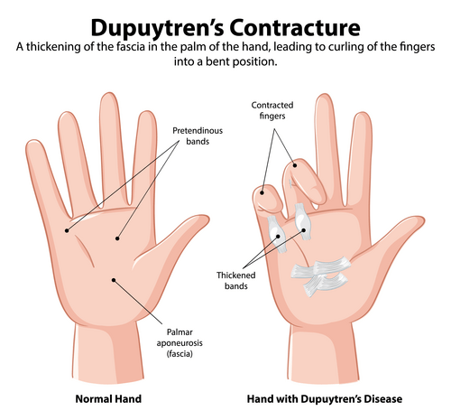 Normal hand vs. hand with Dupuytren's disease