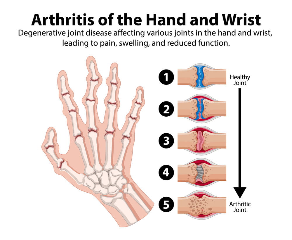 Degenerative joint disease affecting hand and wrist 