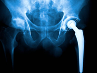Hip X-ray