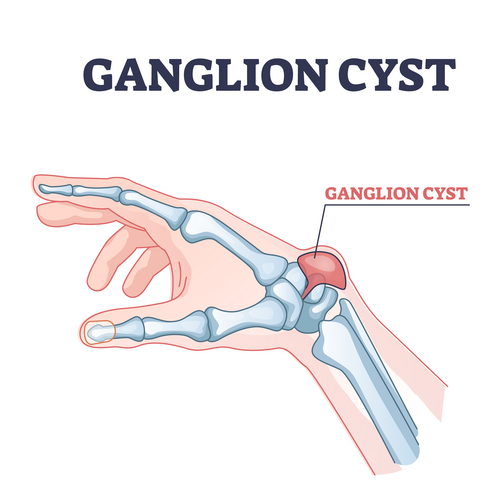 Ganglion cyst as tendon fluid filled swelling near arm joint outline diagram 