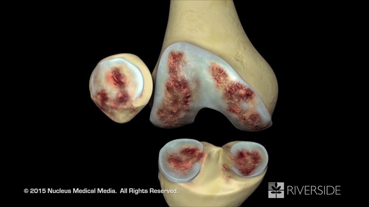 total knee replacement thumbnail