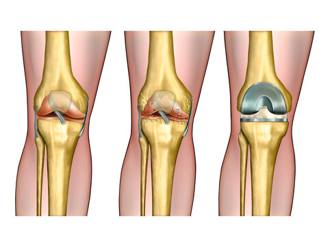 Healthy knee anatomy, degenerative arthritis of the knee and replacement surgery. Digital illustration.