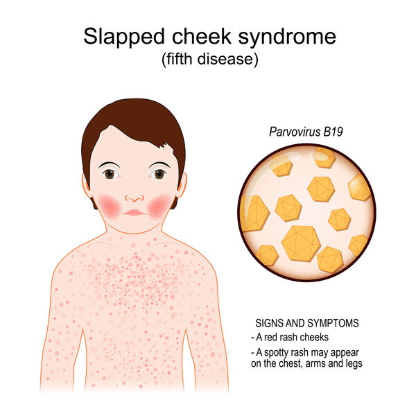 Fifth disease. Signs and symptoms. child has slapped cheek syndrome. Infectious disease. Close-up of Parvovirus B19. Vector illustration