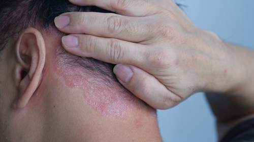 Psoriasis on the nape of a man. skin with psoriasis.