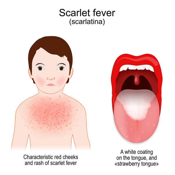 scarlet fever example image