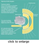 Click to Enlarge Gamma Knife illustration