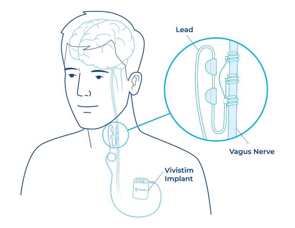 Medical illustration of a person with a chest-implanted stimulator and lead running up the neck; a circular inset enlarges the electrode on a nerve.