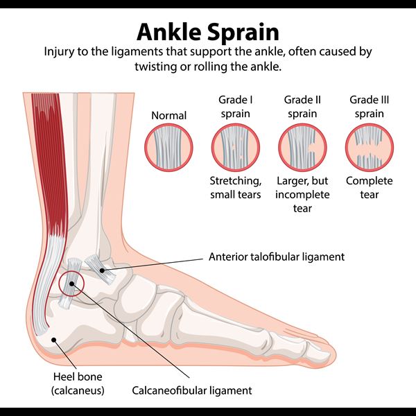 Ankle Sprain