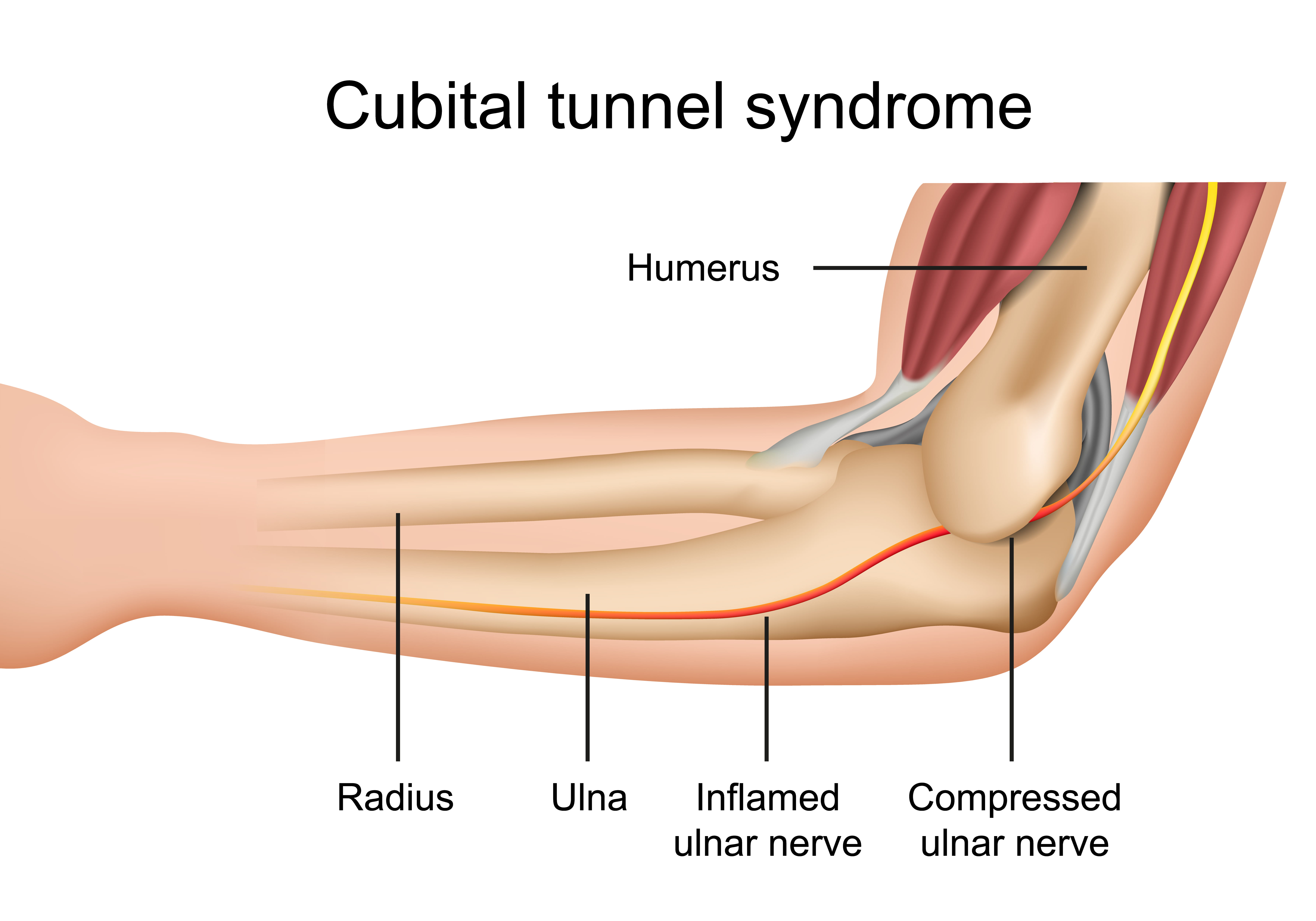 Cubital Tunnel