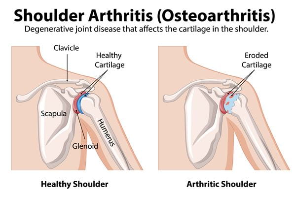 Shoulder Osteoarthritis