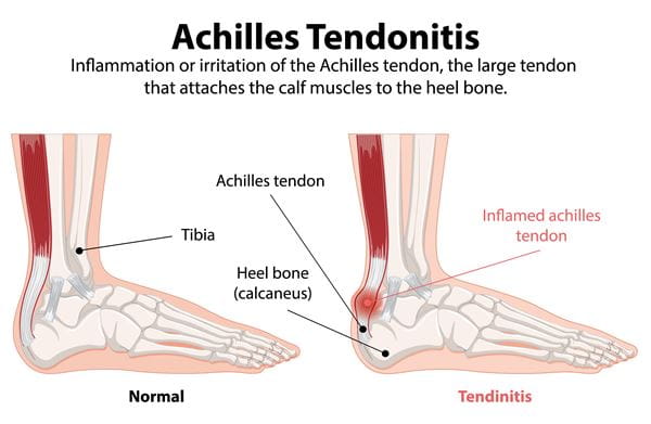 achilles tendonitis