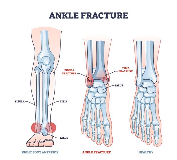 ankle fracture