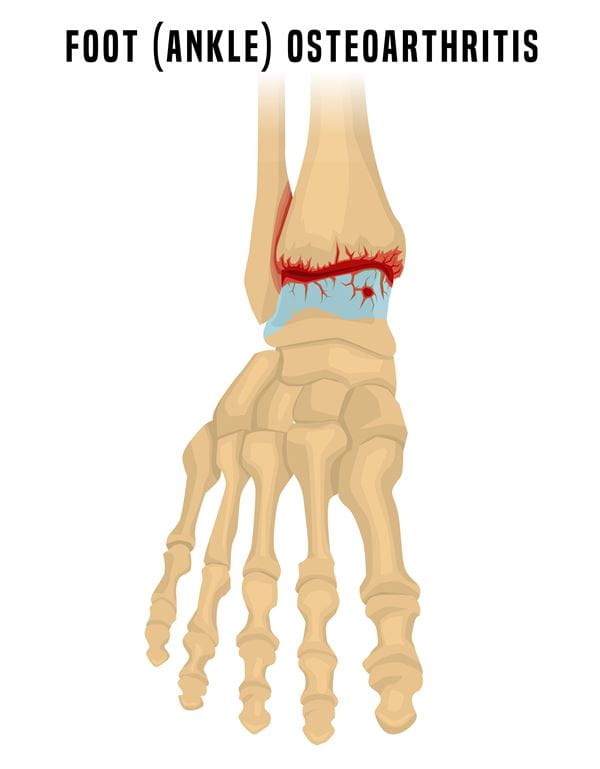 Ankle osteoarthritis