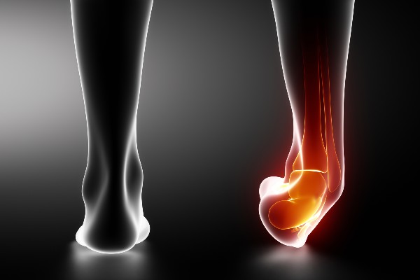Sprained ankle black x-ray