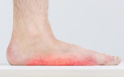 Man with signs of flatfoot foot
