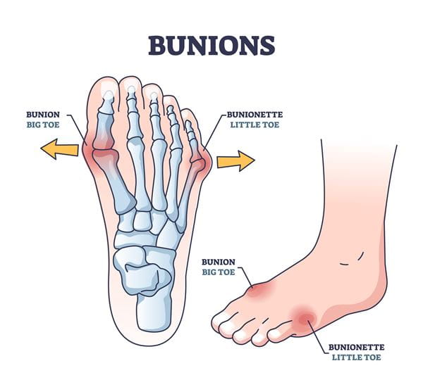 bunions