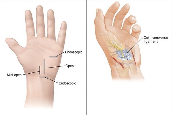 cartoon carpal tunnel surgery plan