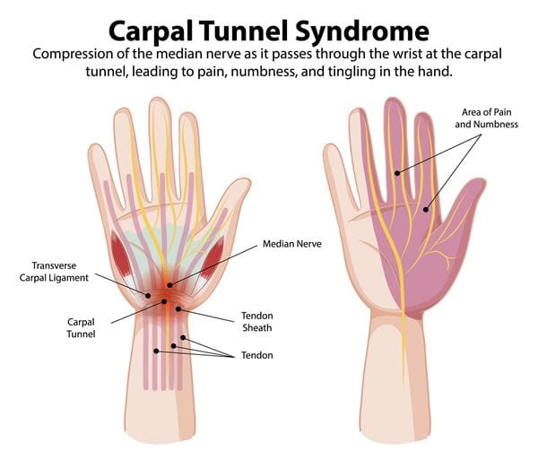 Carpal tunnel syndrome