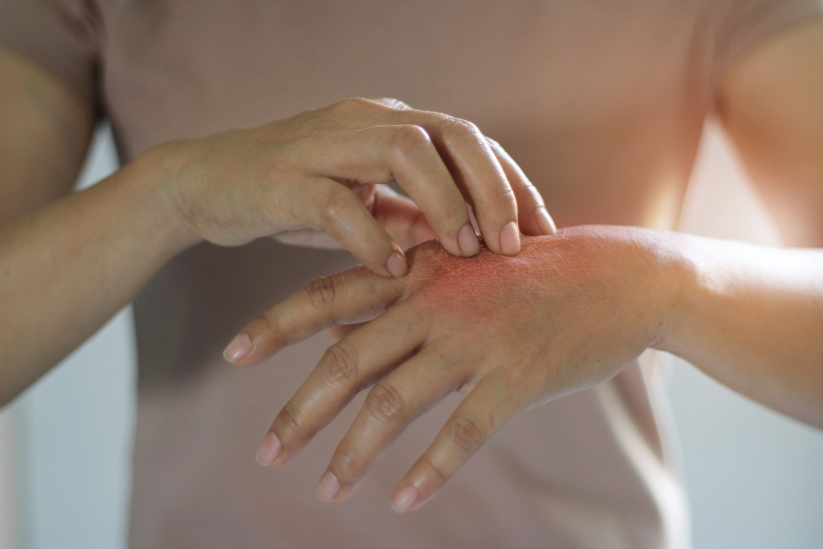 Itchy skin