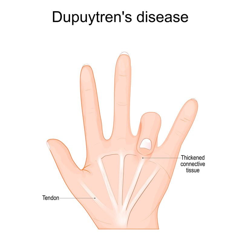 Dupuytrens Disease 