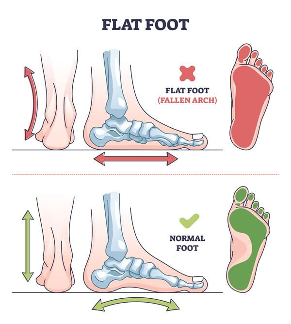 flat foot