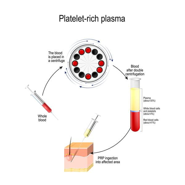 platelet rich plasma
