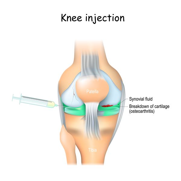 knee injection