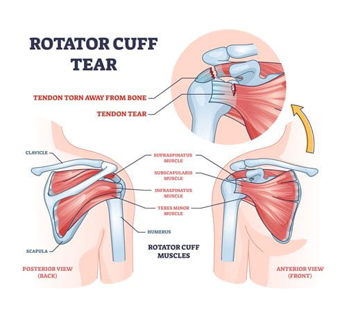 Rotator Cuff Tear
