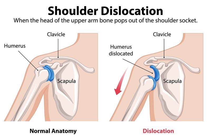 Dislocated Shoulder