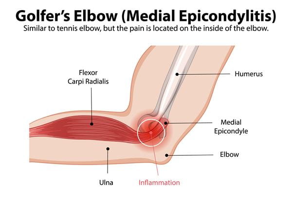 golfers elbow