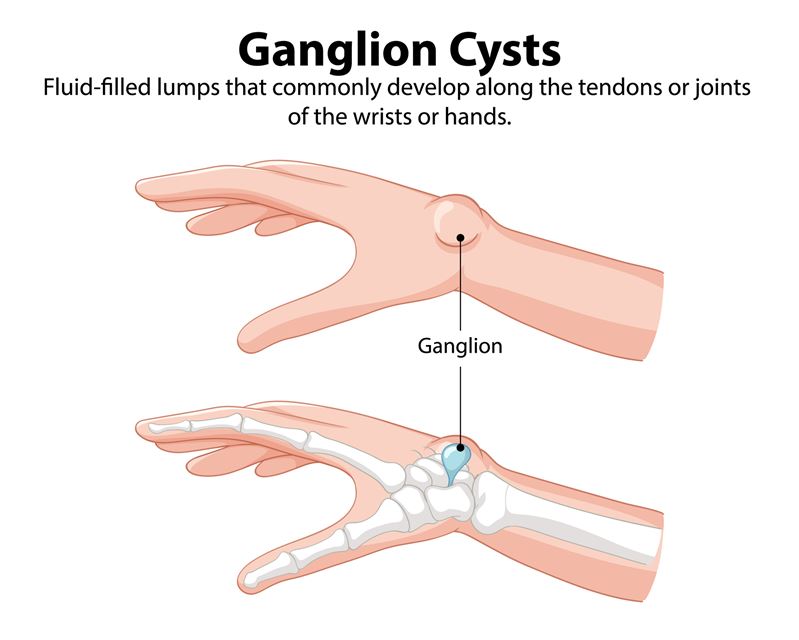 Ganglion Cysts