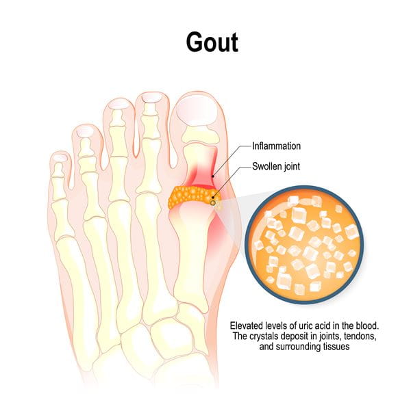 Gout